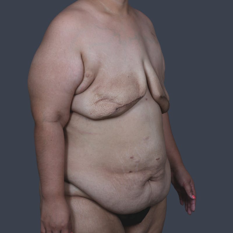 DIEP Flap Before & After Gallery - Patient 646753 - Image 3
