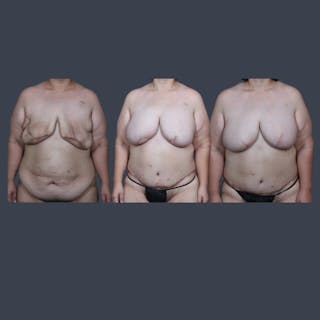 DIEP Flap Before & After Gallery - Patient 646753 - Image 8