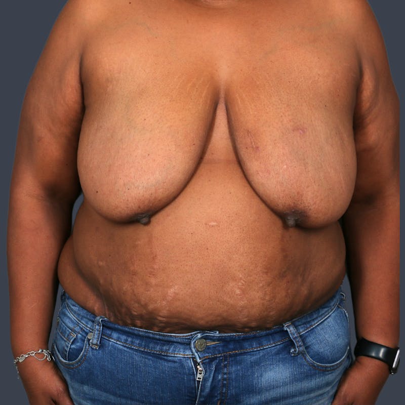 DIEP Flap Before & After Gallery - Patient 418741 - Image 1