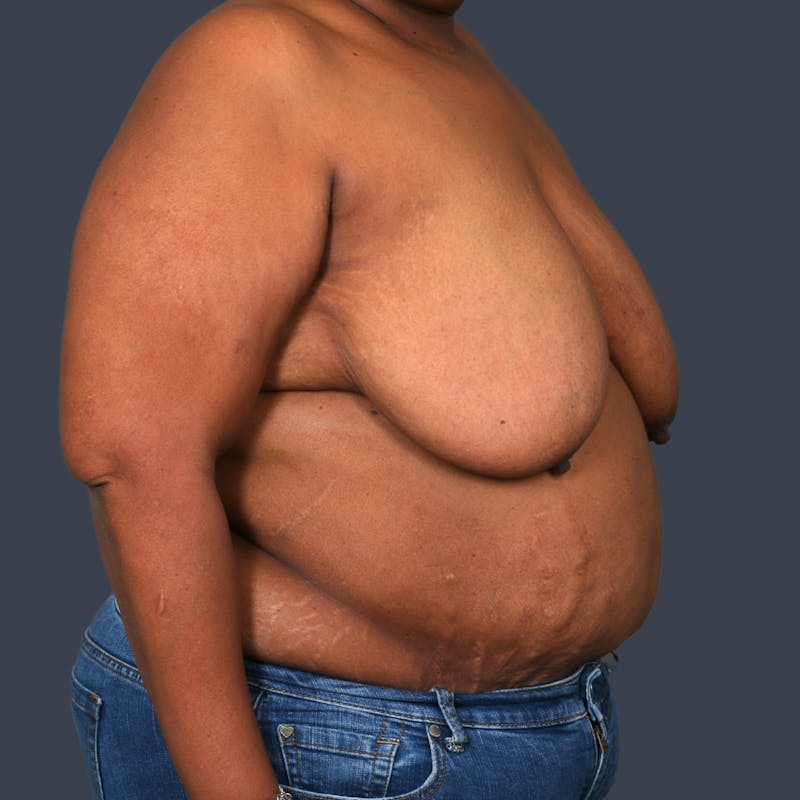 DIEP Flap Before & After Gallery - Patient 418741 - Image 5
