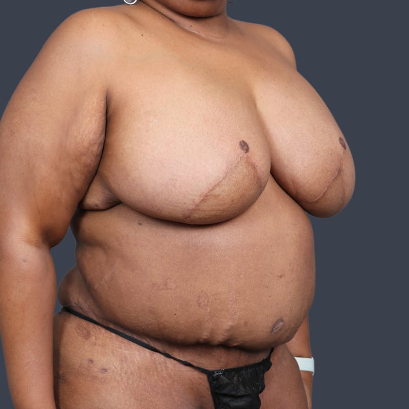 DIEP Flap Before & After Gallery - Patient 418741 - Image 6