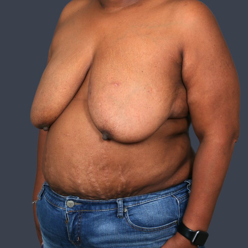 DIEP Flap Before & After Gallery - Patient 418741 - Image 3