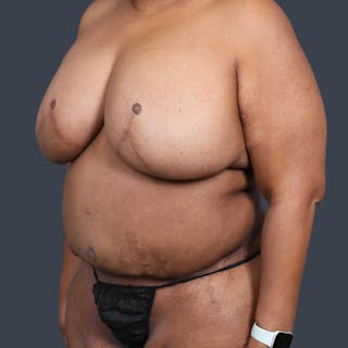 DIEP Flap Before & After Gallery - Patient 418741 - Image 4