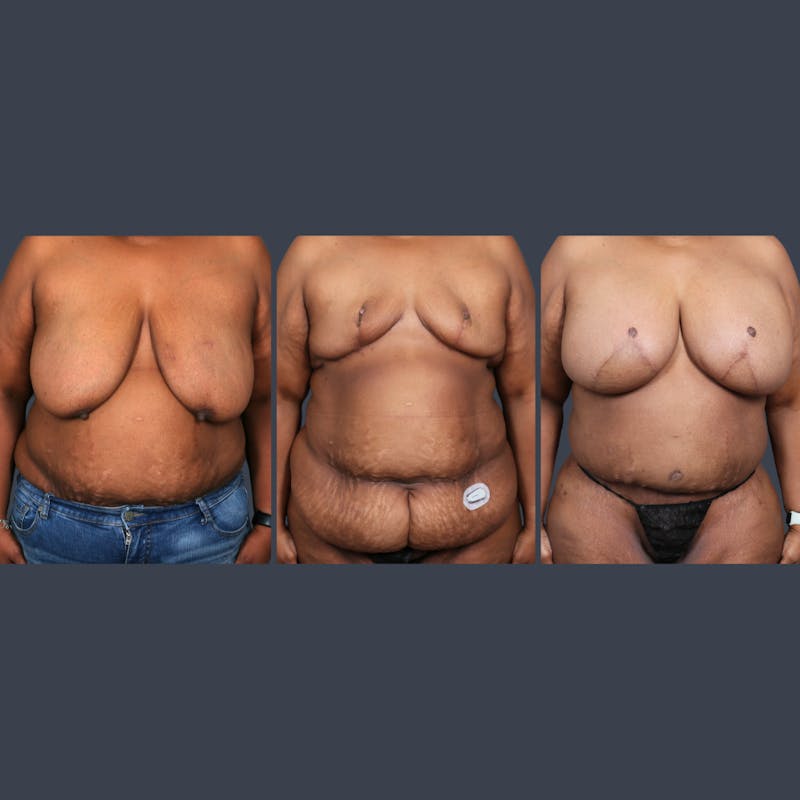 DIEP Flap Before & After Gallery - Patient 418741 - Image 8
