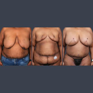 DIEP Flap Before & After Gallery - Patient 418741 - Image 8