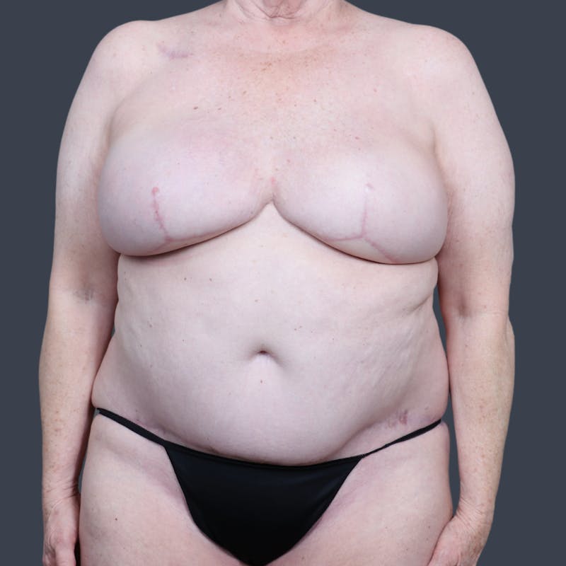 DIEP Flap Before & After Gallery - Patient 196218 - Image 2