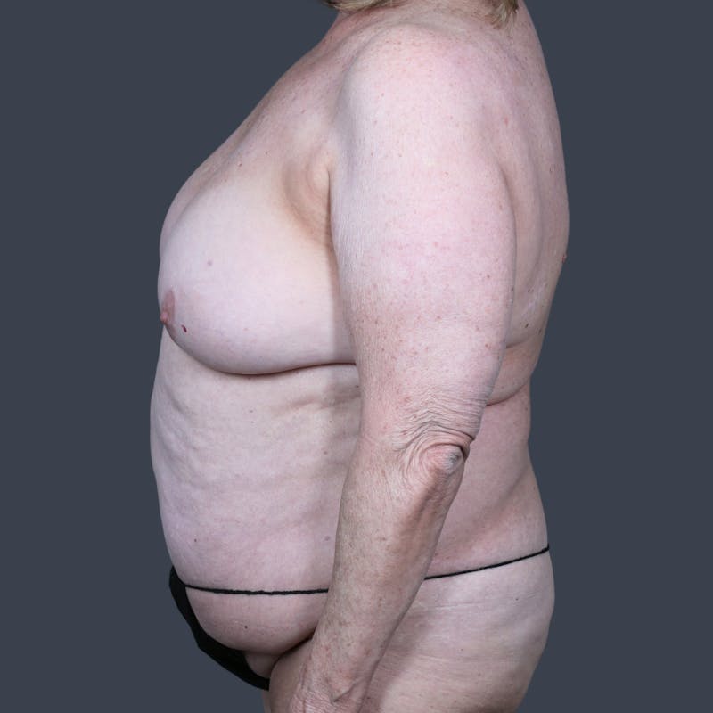 DIEP Flap Before & After Gallery - Patient 196218 - Image 5