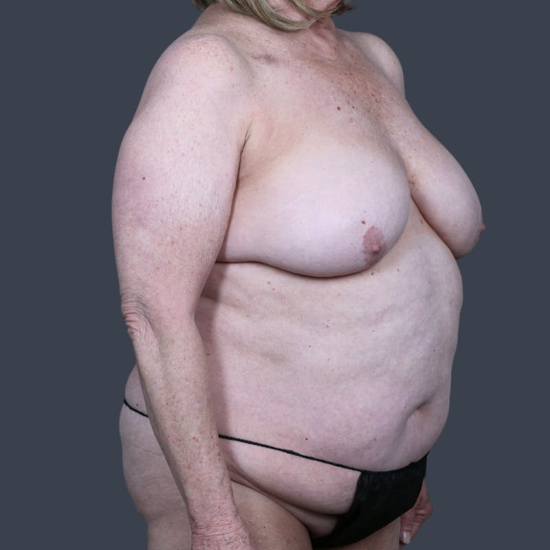 DIEP Flap Before & After Gallery - Patient 196218 - Image 3