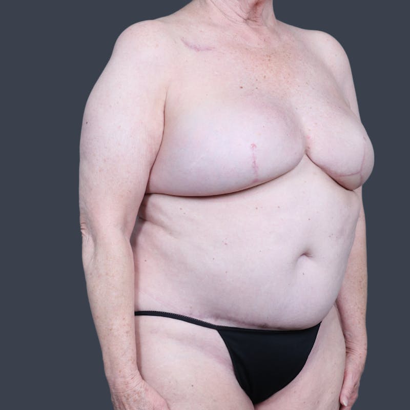 DIEP Flap Before & After Gallery - Patient 196218 - Image 4