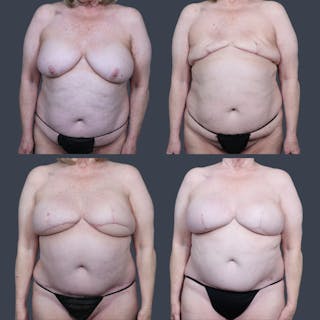 DIEP Flap Before & After Gallery - Patient 196218 - Image 8