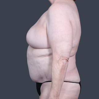 DIEP Flap Before & After Gallery - Patient 196218 - Image 6