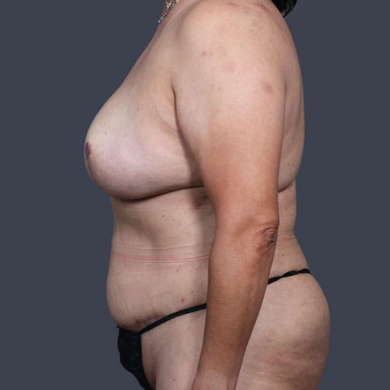 DIEP Flap Before & After Gallery - Patient 364446 - Image 6
