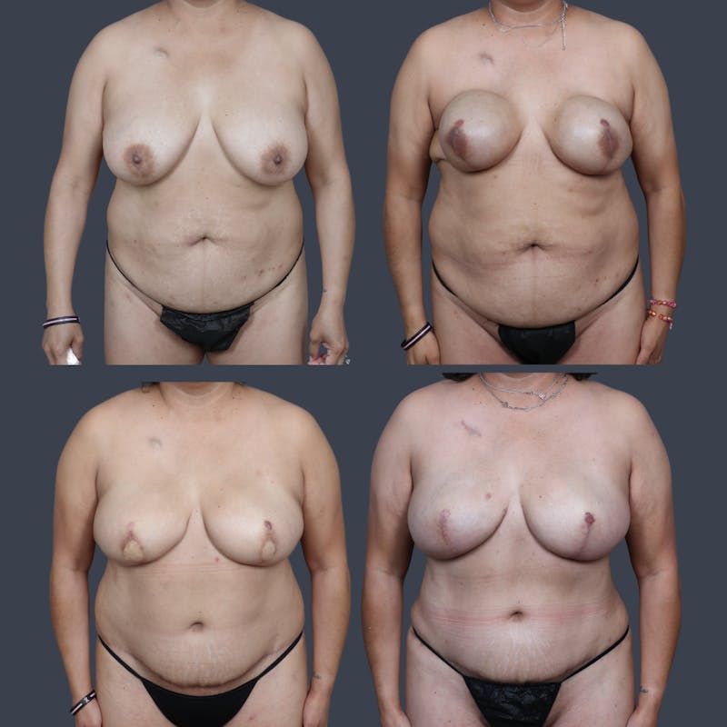 DIEP Flap Before & After Gallery - Patient 364446 - Image 8