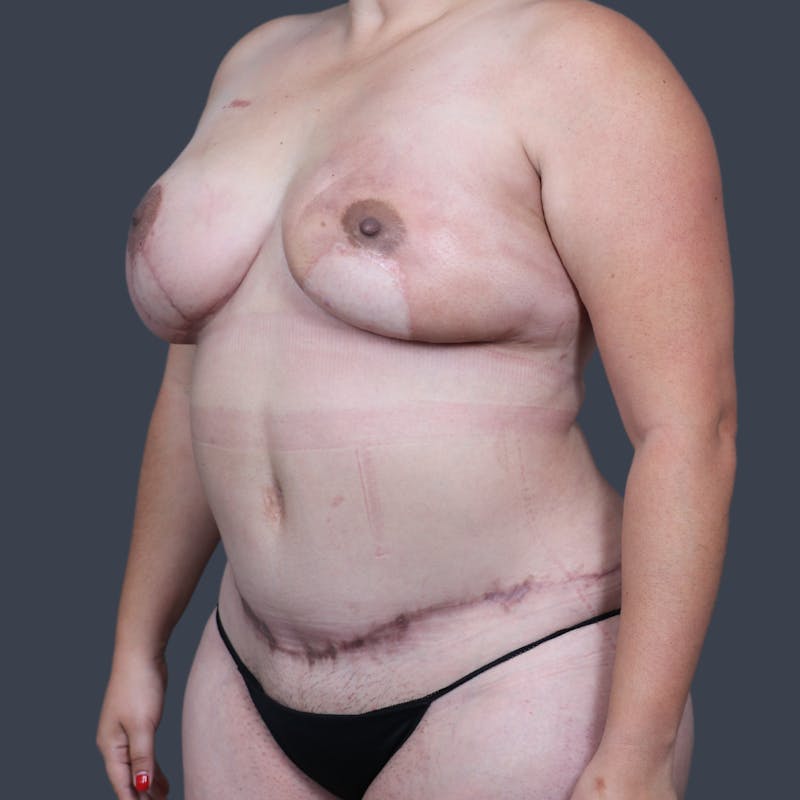 DIEP Flap Before & After Gallery - Patient 247414 - Image 4