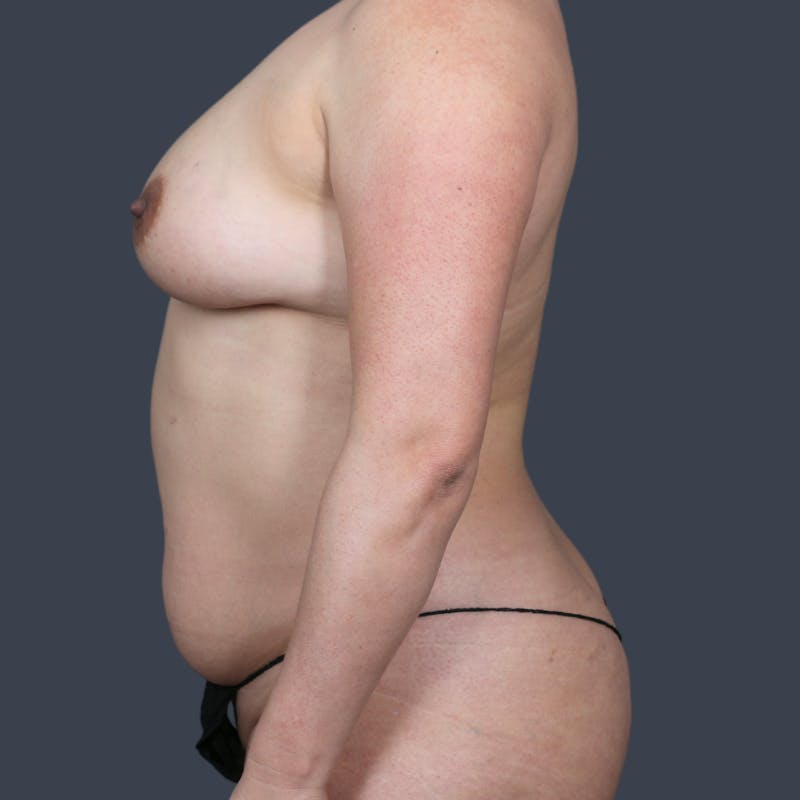 DIEP Flap Before & After Gallery - Patient 247414 - Image 5