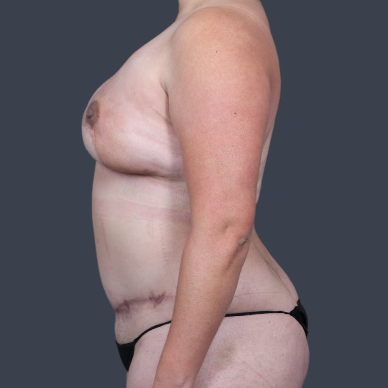 DIEP Flap Before & After Gallery - Patient 247414 - Image 6