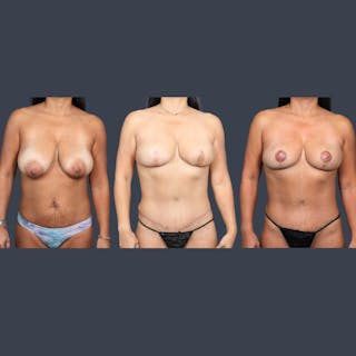 DIEP Flap Before & After Gallery - Patient 392693 - Image 8