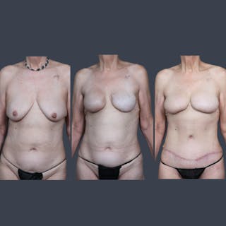 DIEP Flap Before & After Gallery - Patient 249159 - Image 8