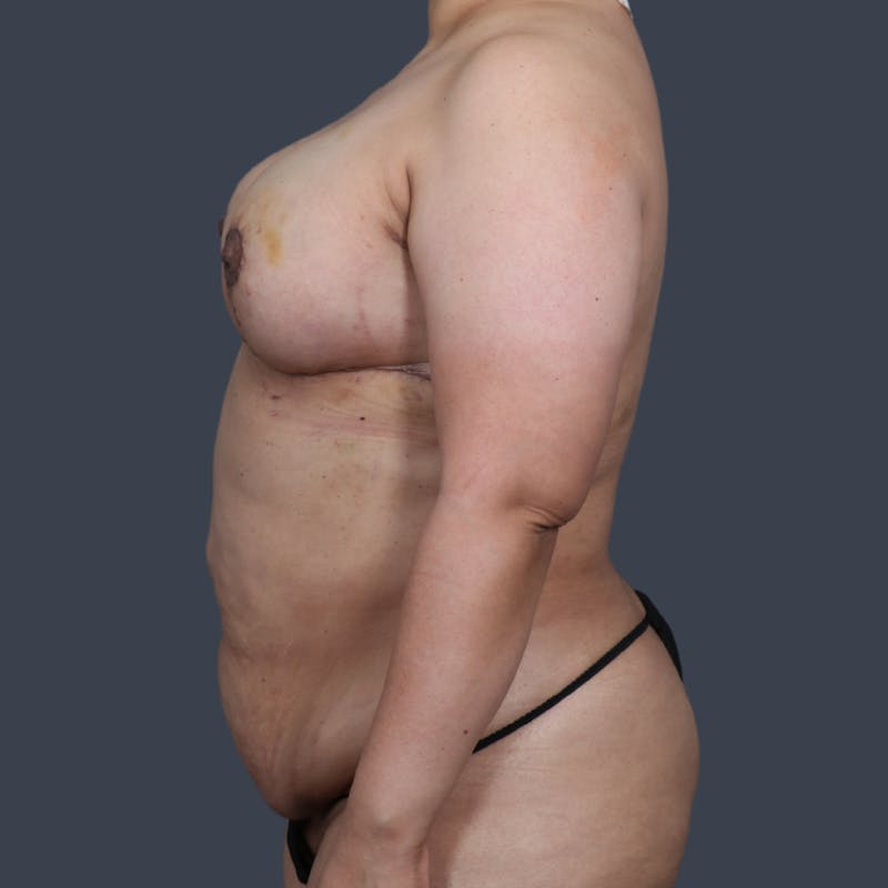 DIEP Flap Before & After Gallery - Patient 323270 - Image 5