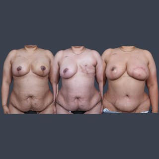 DIEP Flap Before & After Gallery - Patient 323270 - Image 8