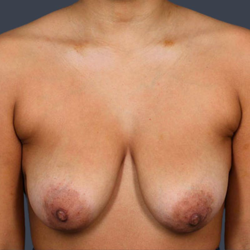 Breast Lift Before & After Gallery - Patient 318218 - Image 1