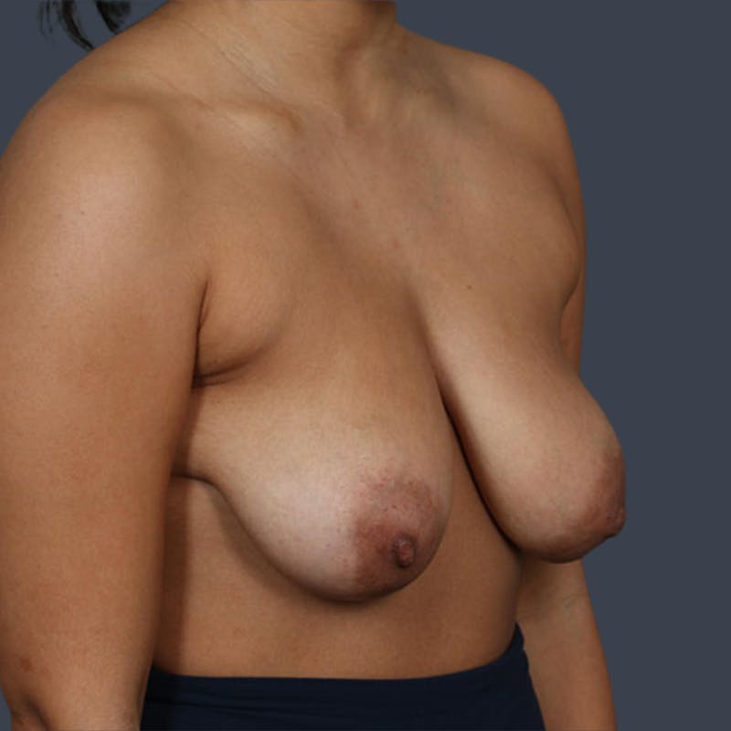 Breast Lift Before & After Gallery - Patient 318218 - Image 3