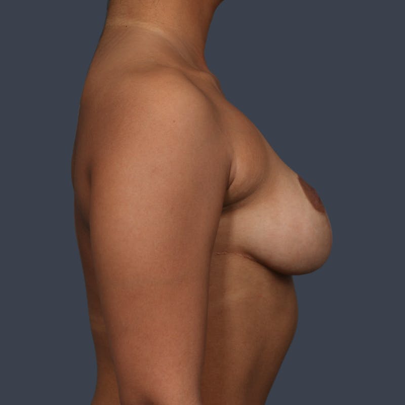 Breast Lift Before & After Gallery - Patient 318218 - Image 6