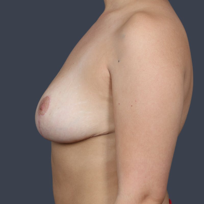 Breast Reduction Before & After Gallery - Patient 200796 - Image 6