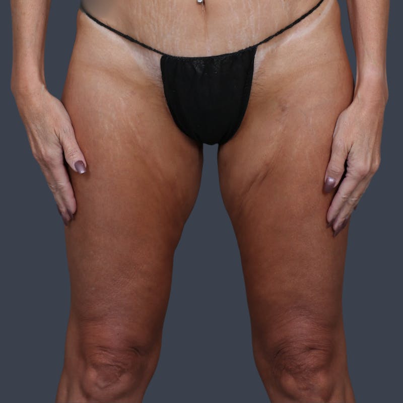Thigh Lift Before & After Gallery - Patient 209263 - Image 2