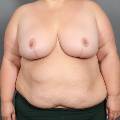 Breast Reduction Before & After Gallery - Patient 108378 - Image 2
