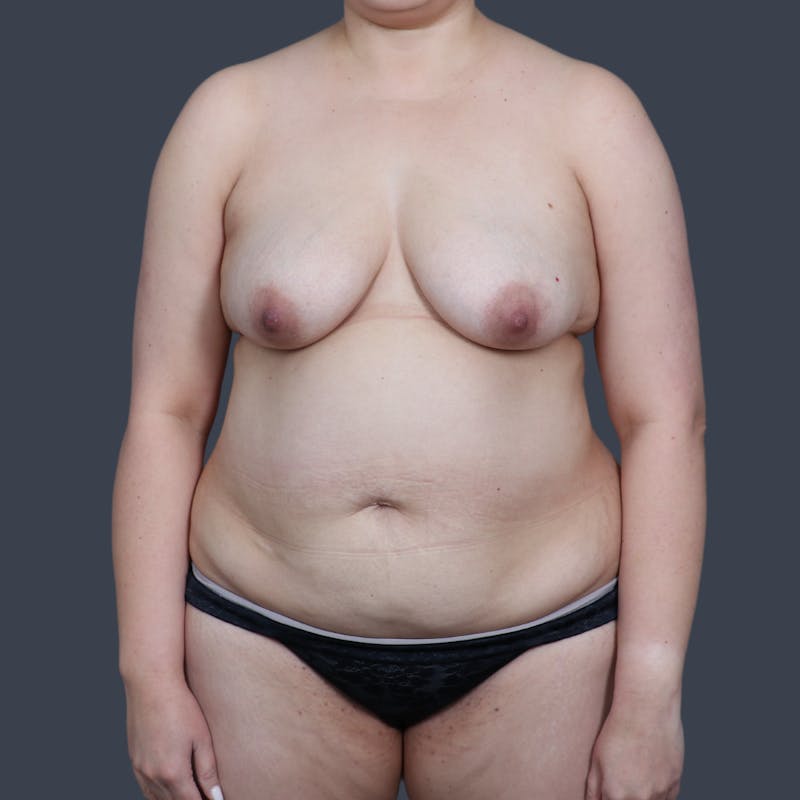 Breast Lift Before & After Gallery - Patient 302222 - Image 1