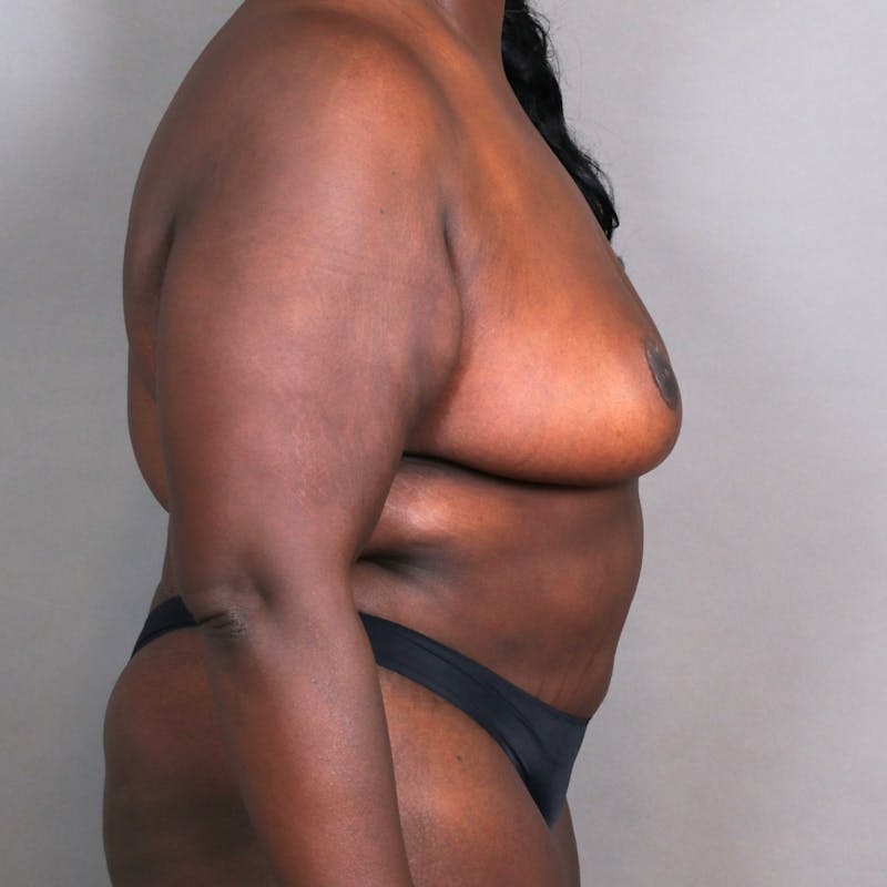 Breast Lift Before & After Gallery - Patient 349008 - Image 4