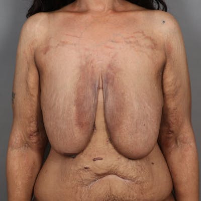 Breast Lift Before & After Gallery - Patient 358935 - Image 1