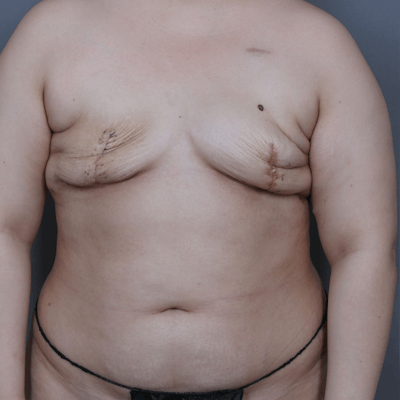 DIEP Flap Before & After Gallery - Patient 382242 - Image 1