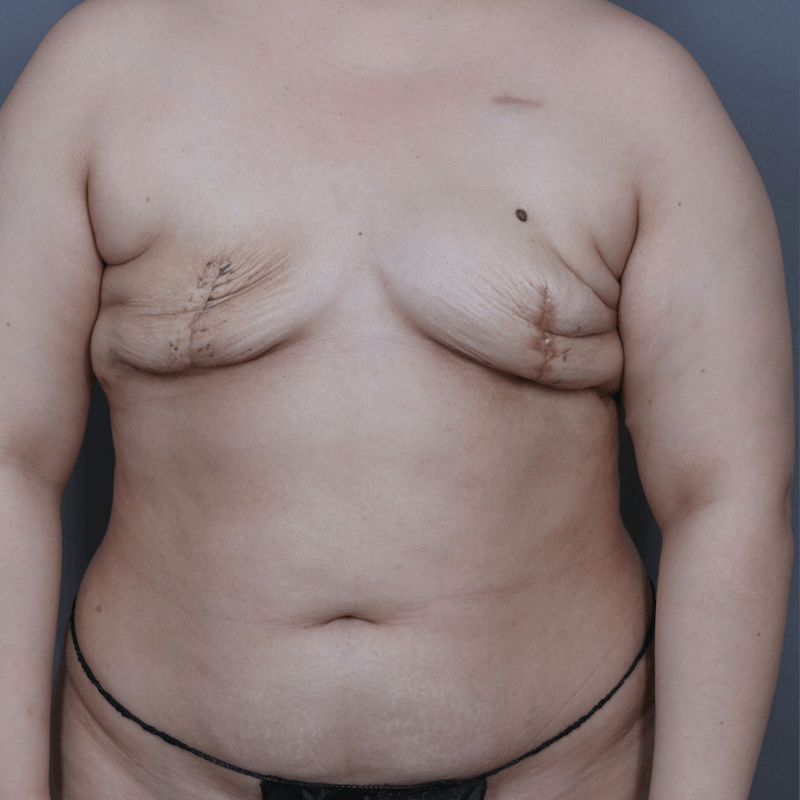 DIEP Flap Before & After Gallery - Patient 382242 - Image 1