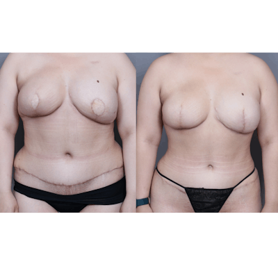 DIEP Flap Before & After Gallery - Patient 382242 - Image 2