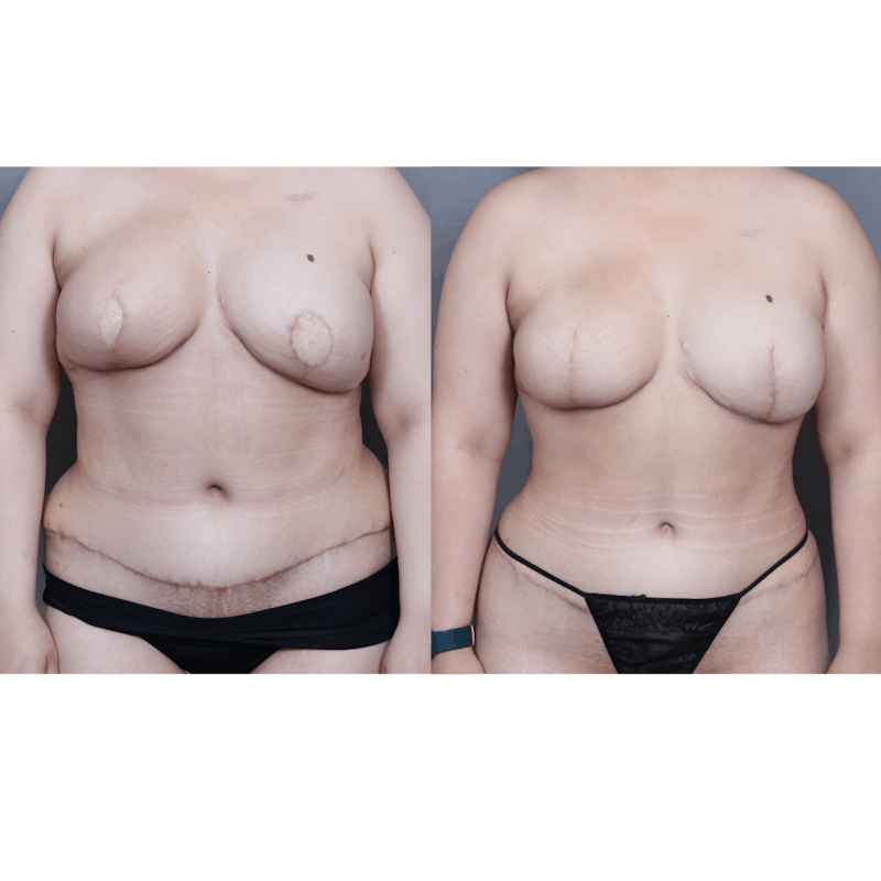 DIEP Flap Before & After Gallery - Patient 382242 - Image 2