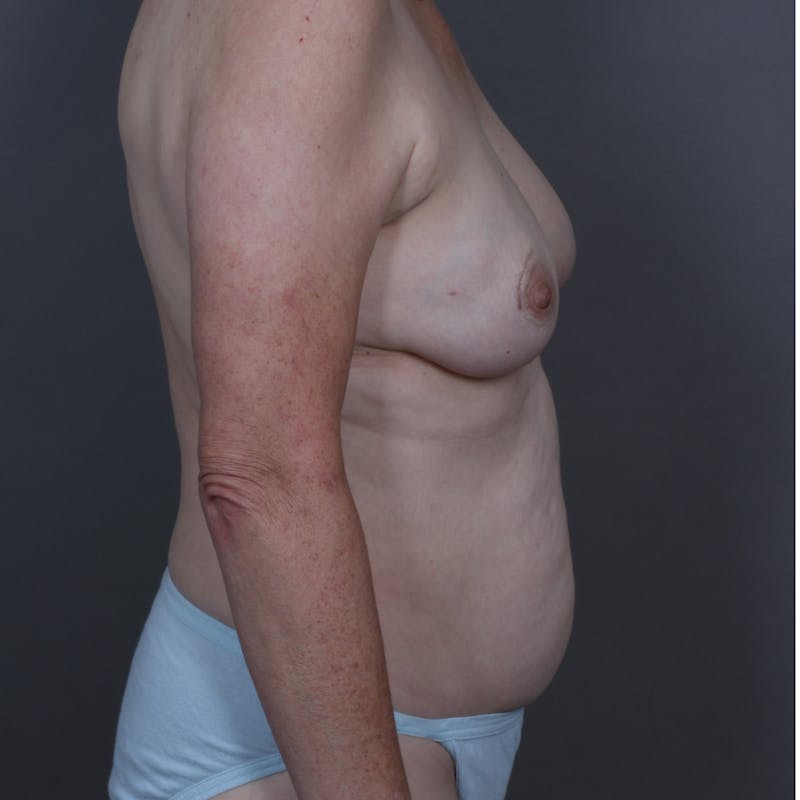 DIEP Flap Before & After Gallery - Patient 353732 - Image 3
