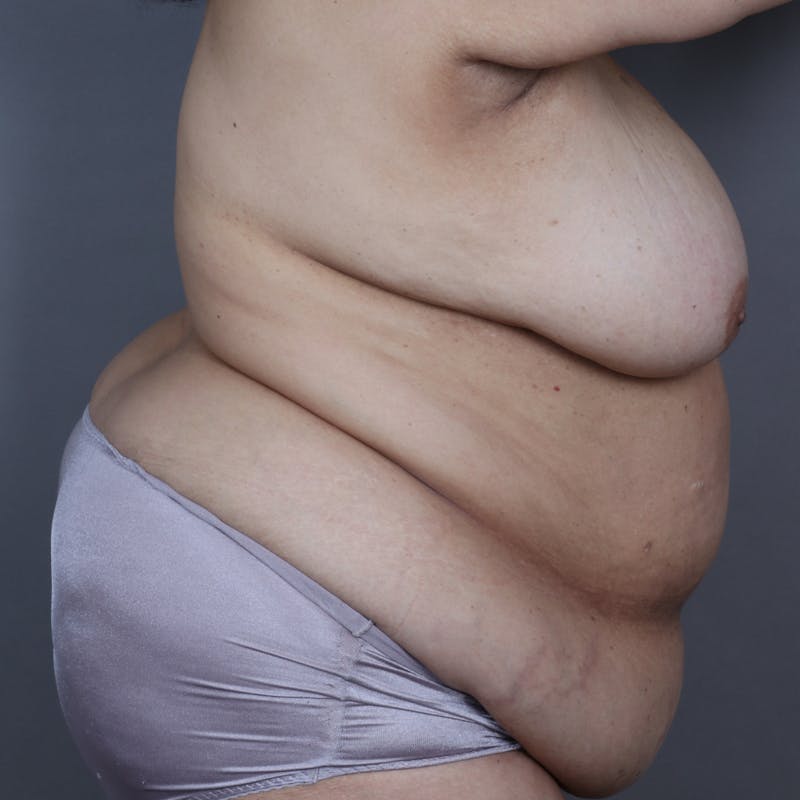 DIEP Flap Before & After Gallery - Patient 189494 - Image 3