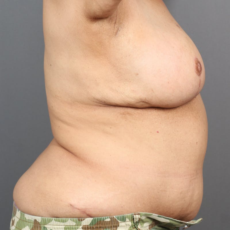 DIEP Flap Before & After Gallery - Patient 189494 - Image 4