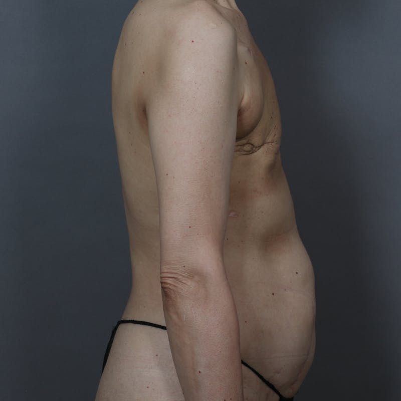 DIEP Flap Before & After Gallery - Patient 966440 - Image 3