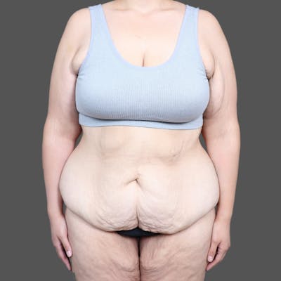 Abdominoplasty / Tummy Tuck Before & After Gallery - Patient 391173 - Image 1
