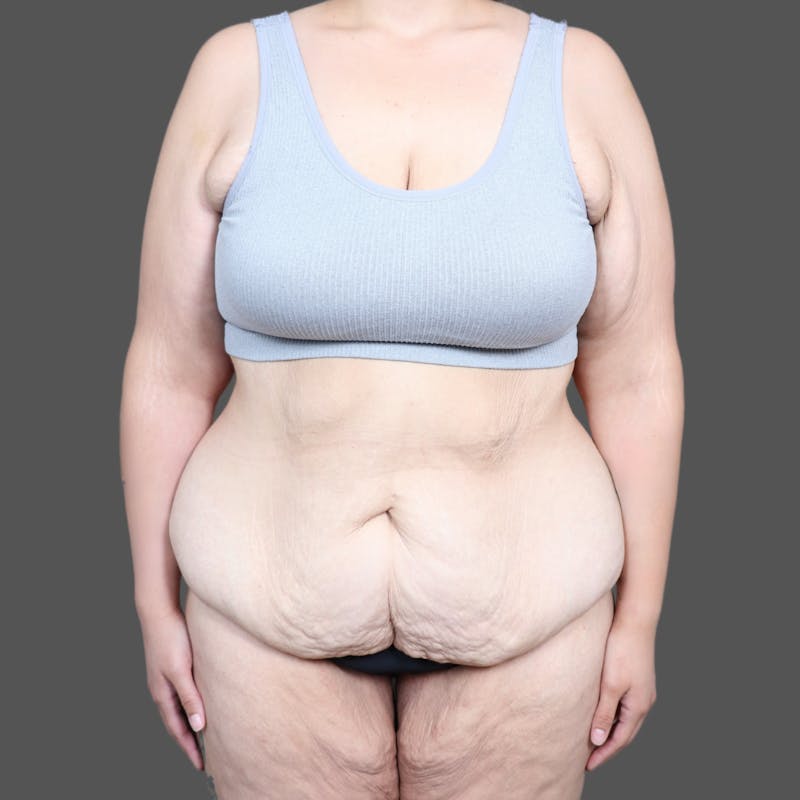 Abdominoplasty / Tummy Tuck Before & After Gallery - Patient 391173 - Image 1