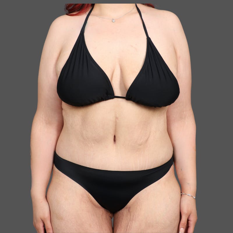 Abdominoplasty / Tummy Tuck Before & After Gallery - Patient 391173 - Image 2