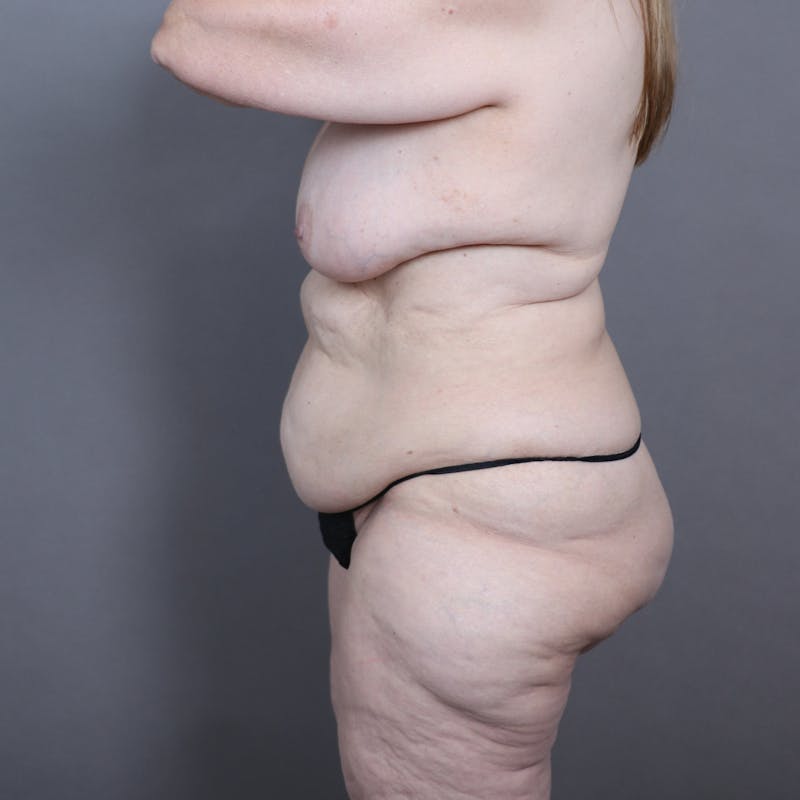 Abdominoplasty / Tummy Tuck Before & After Gallery - Patient 889336 - Image 5