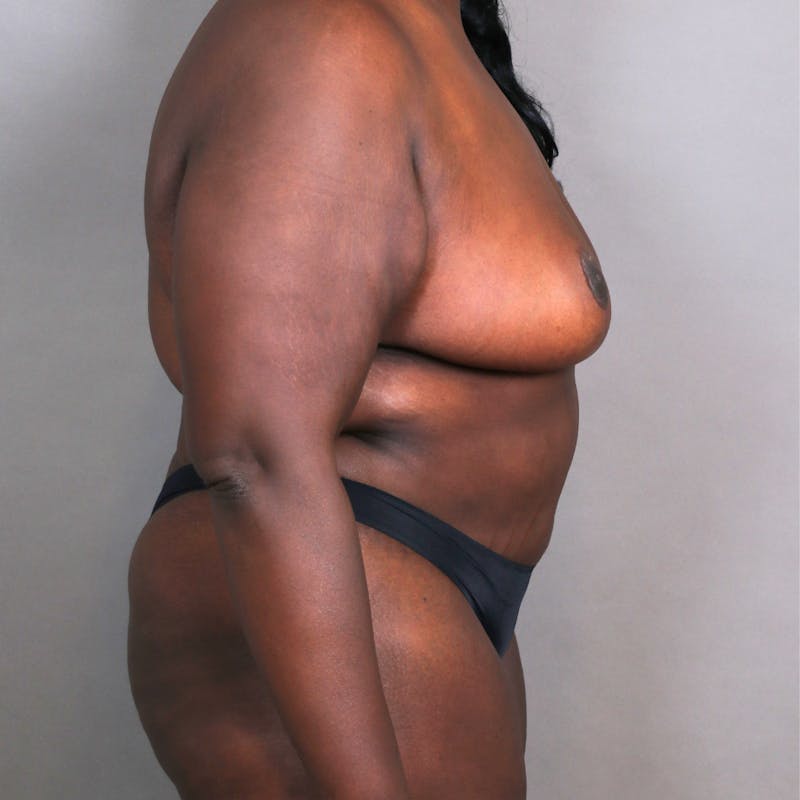Abdominoplasty / Tummy Tuck Before & After Gallery - Patient 115718 - Image 4