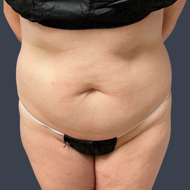 Abdominoplasty / Tummy Tuck Before & After Gallery - Patient 391018 - Image 1