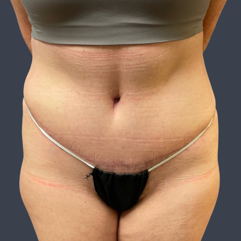 Abdominoplasty / Tummy Tuck Before & After Gallery - Patient 391018 - Image 2