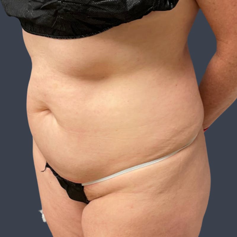 Abdominoplasty / Tummy Tuck Before & After Gallery - Patient 391018 - Image 3