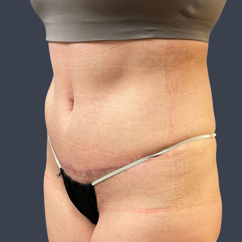 Abdominoplasty / Tummy Tuck Before & After Gallery - Patient 391018 - Image 4